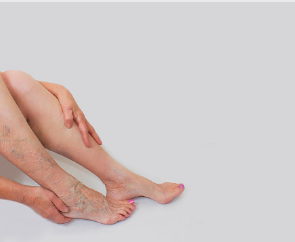 Odyssey-Vein-Clinic varicose vein removal Adelaide